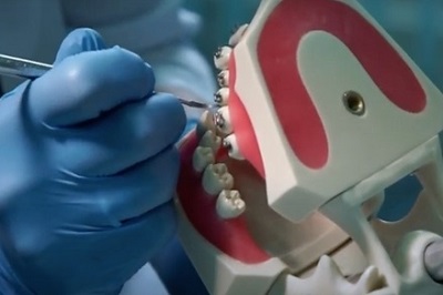 dentasia braces