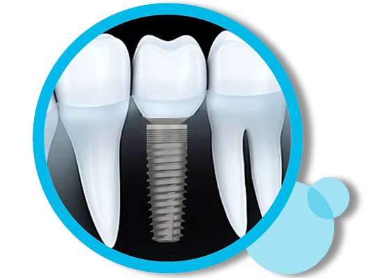 dentaisa implants