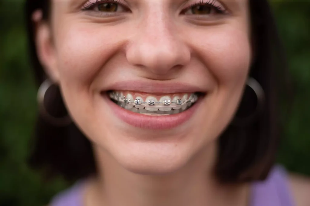 Metal Braces